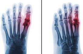 Goutte : augmentation de la mortalité cardiaque avec le fébuxostat