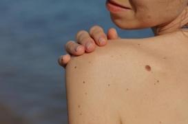 Cancer de la peau : comment reconnaître un grain de beauté suspect?