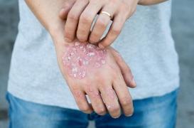 Psoriasis : le sondage qui illustre les idées fausses sur la maladie