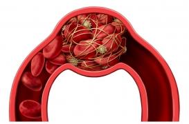 Qu’est-ce que la thrombose, l’effet secondaire qui a entraîné la suspension du vaccin AstraZeneca ?