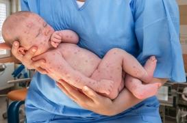Rougeole : augmentation alarmante du nombre de cas en Occitanie, deuxième région la plus touchée