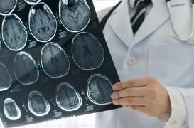 La Covid-19 entraîne des problèmes cérébraux, même dans les formes bénignes