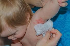 La maladie d'Alzheimer pourrait être causée par le virus de l'herpès