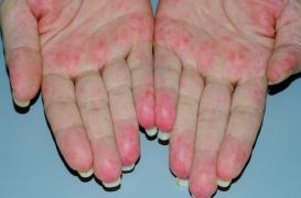 Vascularite à ANCA : réduction en vue des traitements lourds et de la corticothérapie 