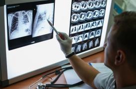 Cancer du poumon : un nouveau modèle de prédiction du risque pour les non-fumeuses