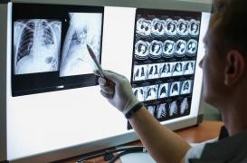 Cancer du poumon : les experts se mobilisent pour un dépistage massif