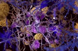 Alzheimer : la baisse du débit sanguin dans le cerveau pourrait (enfin) expliquer la maladie