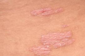 L'eczéma pourrait être causé par votre microbiote intestinal 