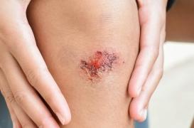 Des scientifiques développent un hydrogel pour soigner les plaies