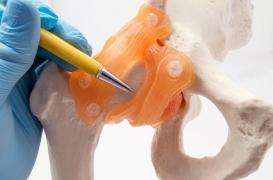 Prothèse de hanche et du genou : combien de temps durent-elle ?