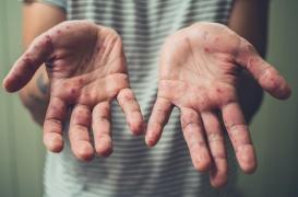 Rougeole : aux Etats-Unis, les enfants non vaccinés bannis des lieux publics