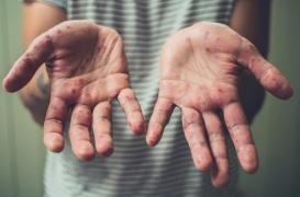 Rougeole : un patient de 26 ans 