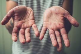 Savoie : une épidémie de rougeole secoue la station de ski de Val Thorens