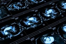 Anévrisme et dissection aortique augmentés par un antibiotique