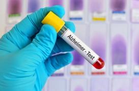 Alzheimer : un test sanguin fiable pour dépister précocement la maladie