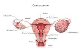 Cancer de l’ovaire : ce que chaque femme devrait savoir