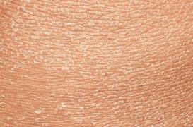 Peau sèche en hiver : 5 conseils pour la protéger et l'hydrater 
