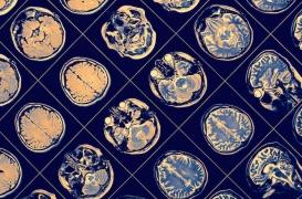 Big Data : l’inflammation aggrave le risque de Parkinson et sa réduction le réduit