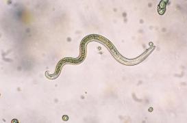 Victime de migraines: les médecins lui découvrent un ver logé dans le cerveau depuis 10 ans