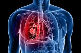 Cancer du poumon : allongement décisif de la survie si une thérapie ciblée est possible