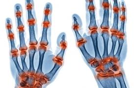 Polyarthrite rhumatoïde : il sera bientôt possible de la prévenir