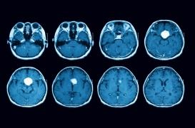Fourmillements dans la main : c’était une tumeur cérébrale