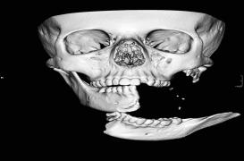 Défigurée lors d'un accident de cheval, une adolescente se refait faire le visage 