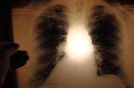 Tuberculose : un candidat-vaccin plus efficace que le BCG