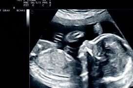 Interruption de grossesse ratée : le bébé est inopérable