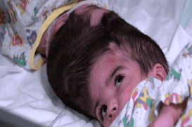 Royaume-Uni : deux sœurs siamoises, liées par la tête, ont été séparées 