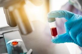 Cancer de la prostate : des risques de faux positifs avec la biopsie liquide 