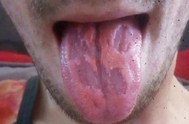 Sa langue est rongée par les boissons énergisantes, il alerte