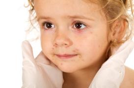 Châtenay-Malabry : les parents redoutent une épidémie de gale