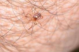 L'anaphylaxie, une réaction allergique grave causée par une morsure de tique  