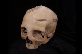 Cancer : un crâne égyptien vieux de 4.000 ans révèle des tentatives de traitement