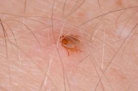 Maladie de Lyme : des patients campent devant le ministère de la Santé