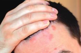 Psoriasis : un trio de protéines en cause ? 