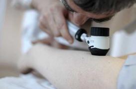 Mélanome avancé : une virothérapie bientôt acceptée en Europe 