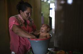 Grossesse : Zika multiplie par 50 le risque de microcéphalie