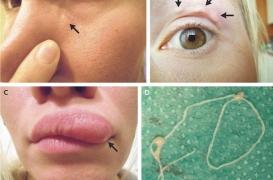 Russie : un ver rampe sous la peau de son visage pendant deux semaines 