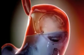 Obésité : un ballon se gonfle dans l’estomac pour manger moins