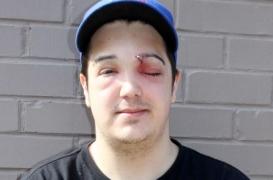 Un Canadien a failli perdre la vue en crevant un bouton 