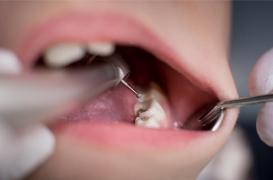 La MIH : une maladie des dents de l’enfant encore méconnue 