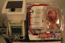  Mélanome : les transplantés deux fois plus exposés 