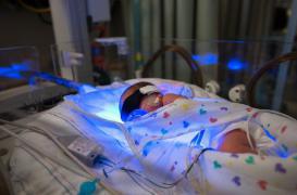 Jaunisse : la photothérapie augmenterait le risque de leucémie