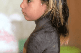 A 4 ans, Haroua souffre d'une forme rare d'une maladie de peau qui couvre en partie son corps de poils