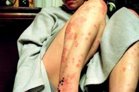Psoriasis : les formes sévères favorisent un décès précoce
