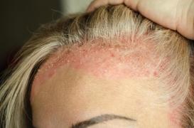 Eczéma et psoriasis : vers de nouveaux traitements