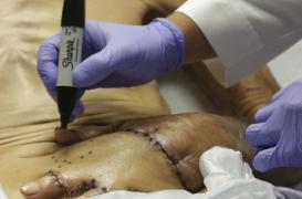 Grâce à une main cousue dans son ventre, Frank Reyes évite l'amputation 