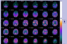 Dépression : un marqueur permet de prédire rapidement la réponse au traitement